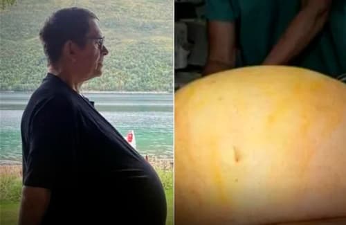 Alemão descobre tumor gigante após 12 anos de diagnóstico errado de obesidade