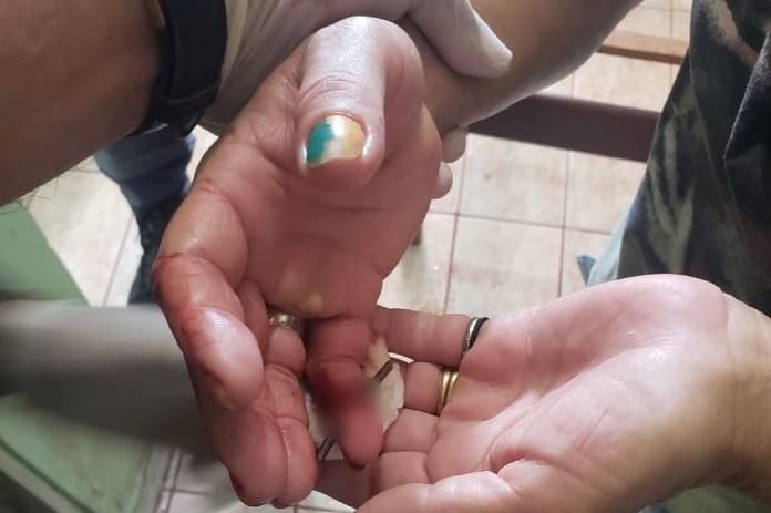 Mulher é socorrida com prego atravessado em dedo