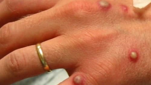 Cantor morre após complicações da monkeypox