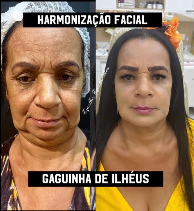 Gaga de Ilhéus passa por harmonização facial e resultado surpreende; confira