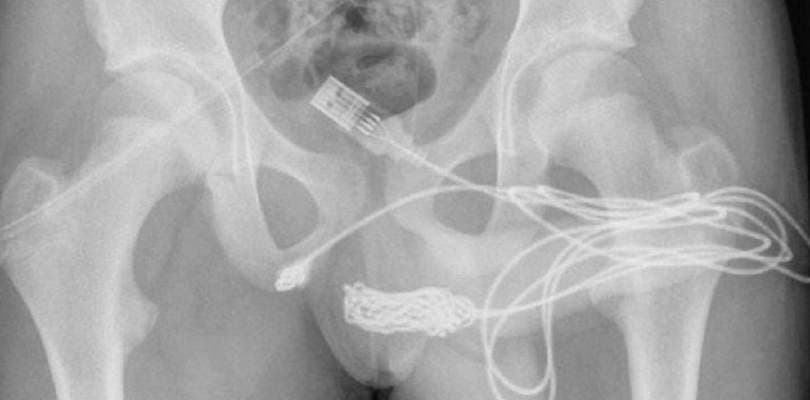 Adolescente passa por cirurgia após ficar com cabo USB preso no pênis