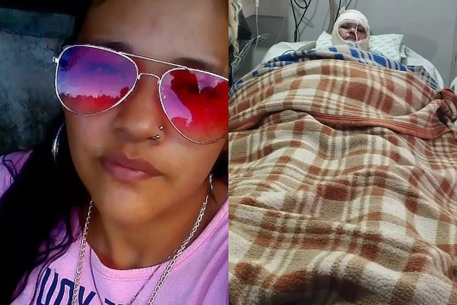 Mulher acorda de coma, acusa marido de tê-la queimado e morre em seguida