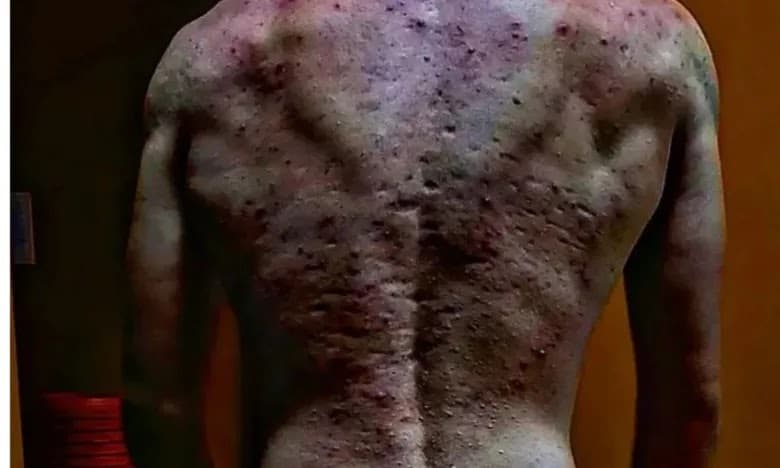 Jovem desenvolve quadro grave de acne por causa de anabolizante