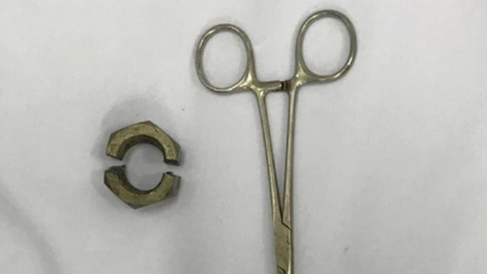 Homem tem pênis estrangulado por usar porca de aço durante masturbação