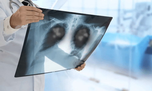 Quase 2 mil pessoas já morreram com pneumonia na Bahia em 2024
