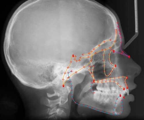 Humanos estão evoluindo mais rápido: dentes do siso estão desaparecendo