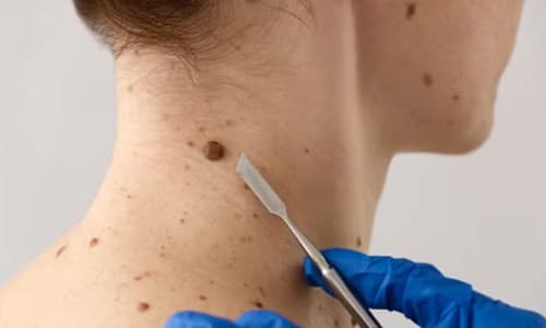 Bahia registra mais de 10 mil casos de câncer de pele por ano