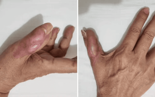 Mulher perde parte do dedo ao contrair infecção após fazer a unha em salão de beleza