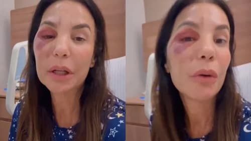 Ivete Sangalo nega rumores de agressão após aparecer com hematomas no rosto