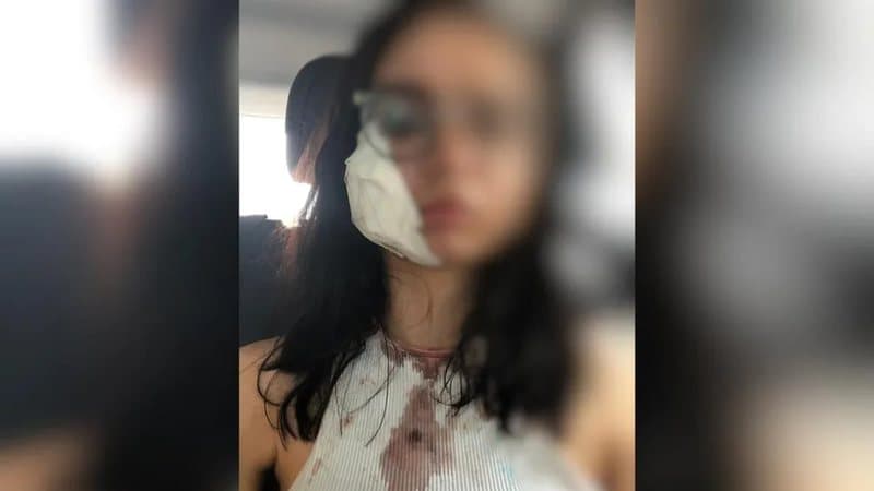Garota tem parte da bochecha arrancada com mordida do ex-namorado