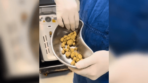Médico retira 35 pedras da bexiga de homem que bebia até 3 litros de refrigerante por dia
