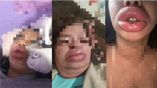 Falsa Biomédica é indiciada por deformação facial em clientes