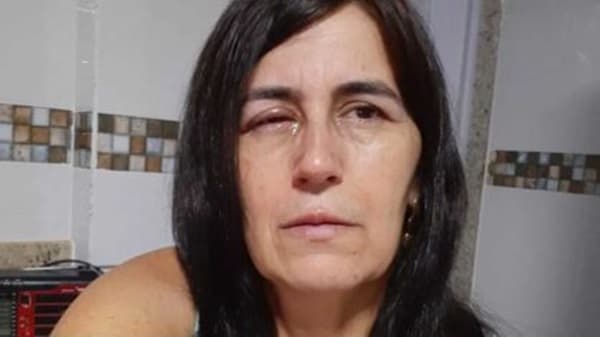 Em vez de colírio, mulher usa supercola no olho e termina socorrida